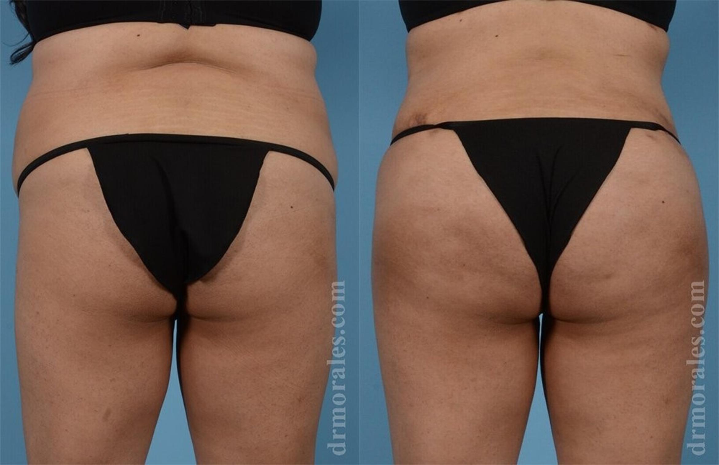 Before & After Brazilian Butt Lift Case 366 View 1 View in Houston, TX