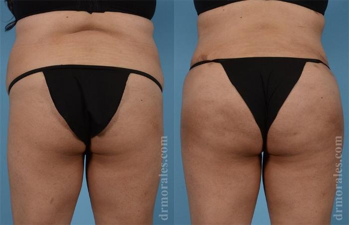 Before & After Brazilian Butt Lift Case 366 View 1 View in Houston, TX