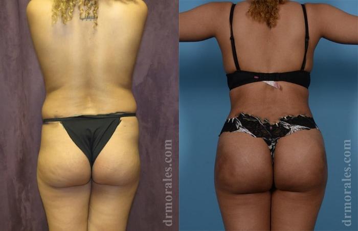Before & After Brazilian Butt Lift Case 367 View 1 View in Houston, TX