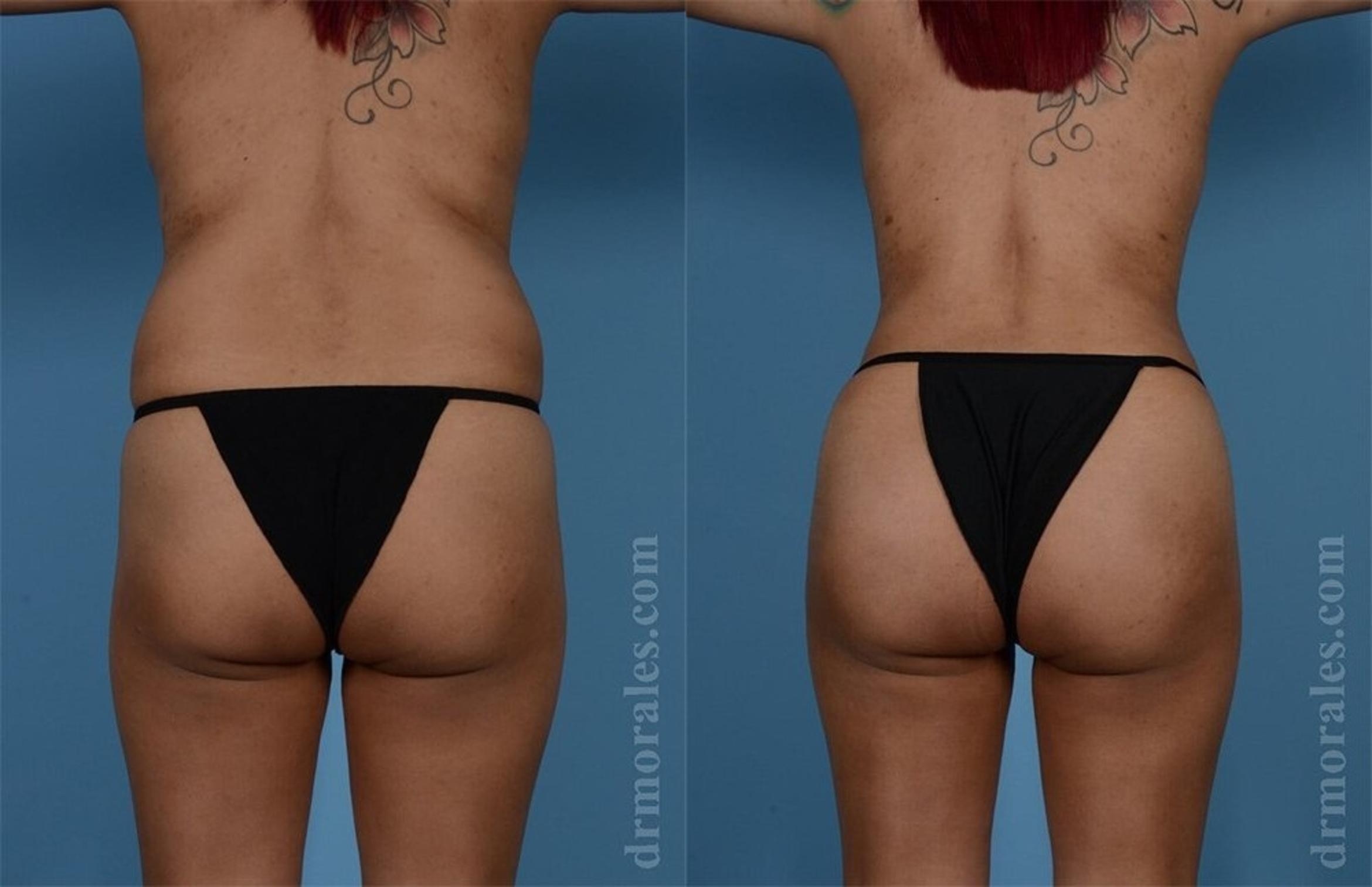 Before & After Brazilian Butt Lift Case 368 View 1 View in Houston, TX
