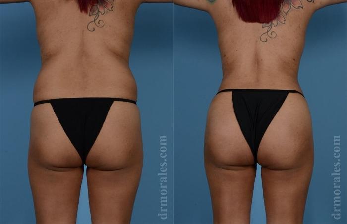 Before & After Brazilian Butt Lift Case 368 View 1 View in Houston, TX