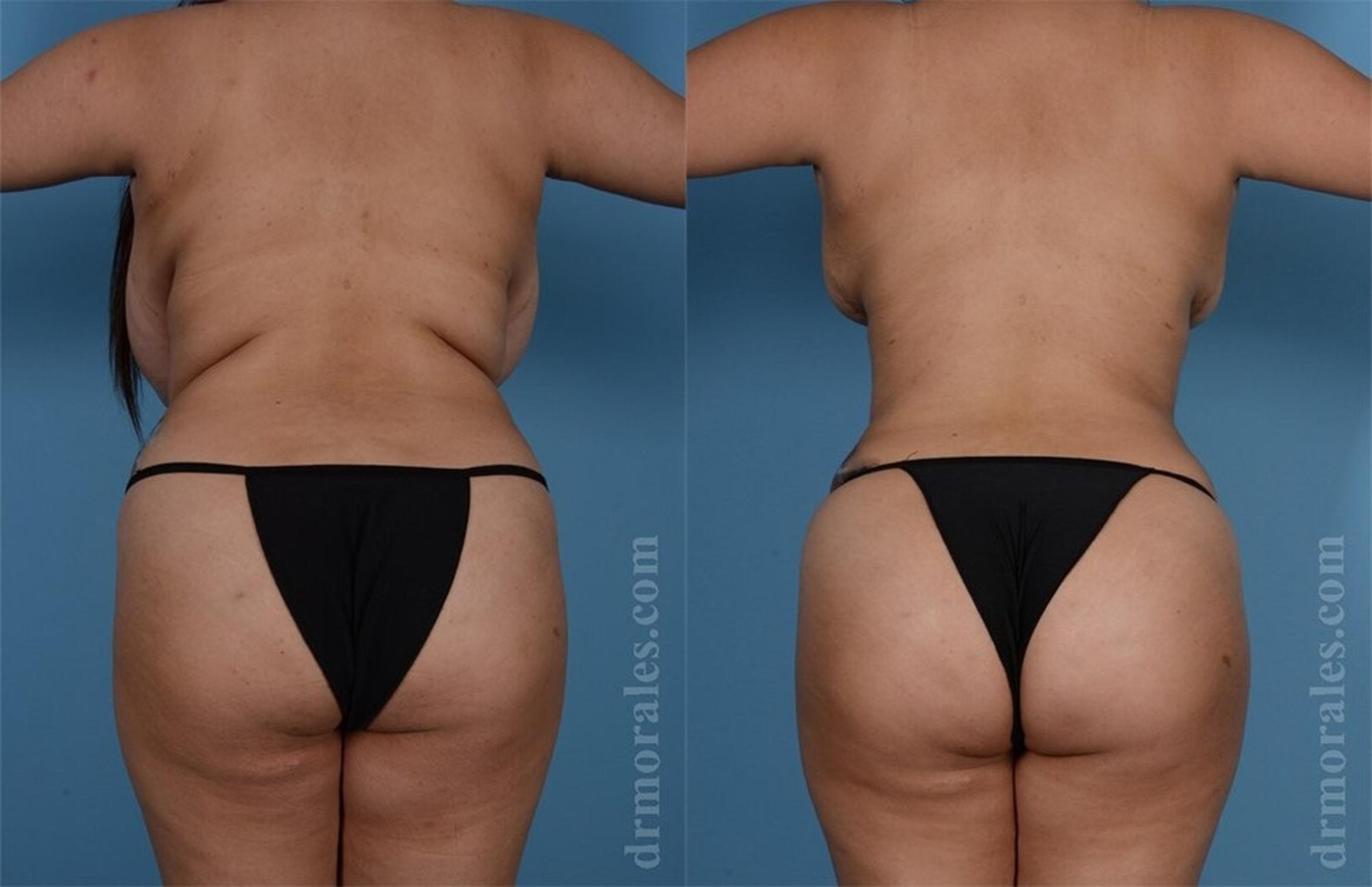Before & After Brazilian Butt Lift Case 369 View 1 View in Houston, TX