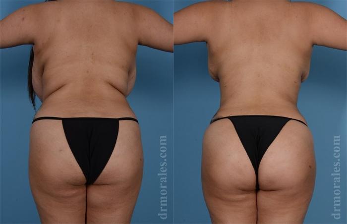 Before & After Brazilian Butt Lift Case 369 View 1 View in Houston, TX