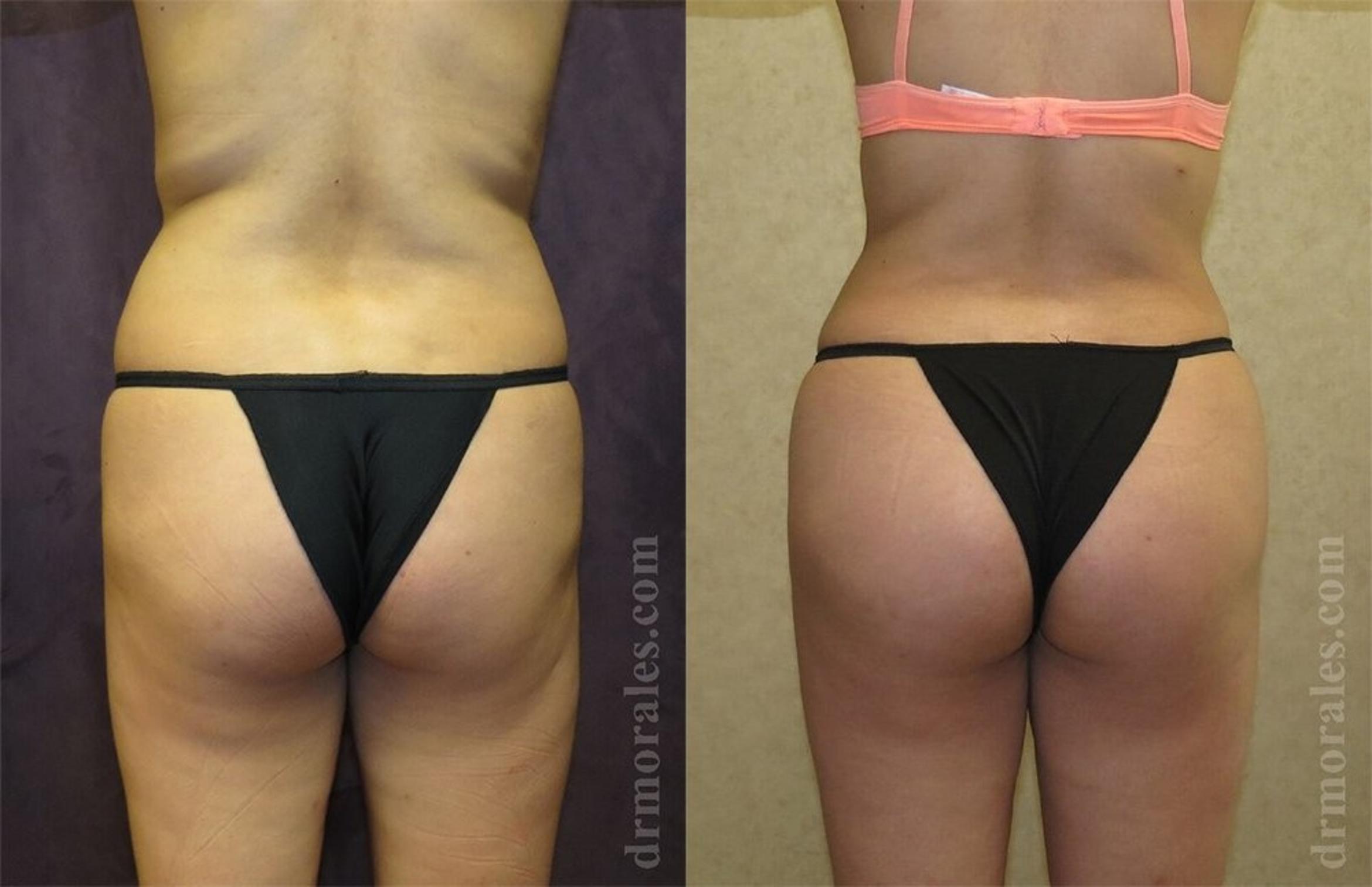 Before & After Brazilian Butt Lift Case 370 View 1 View in Houston, TX