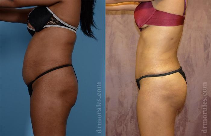 Before & After Brazilian Butt Lift Case 371 View 1 View in Houston, TX