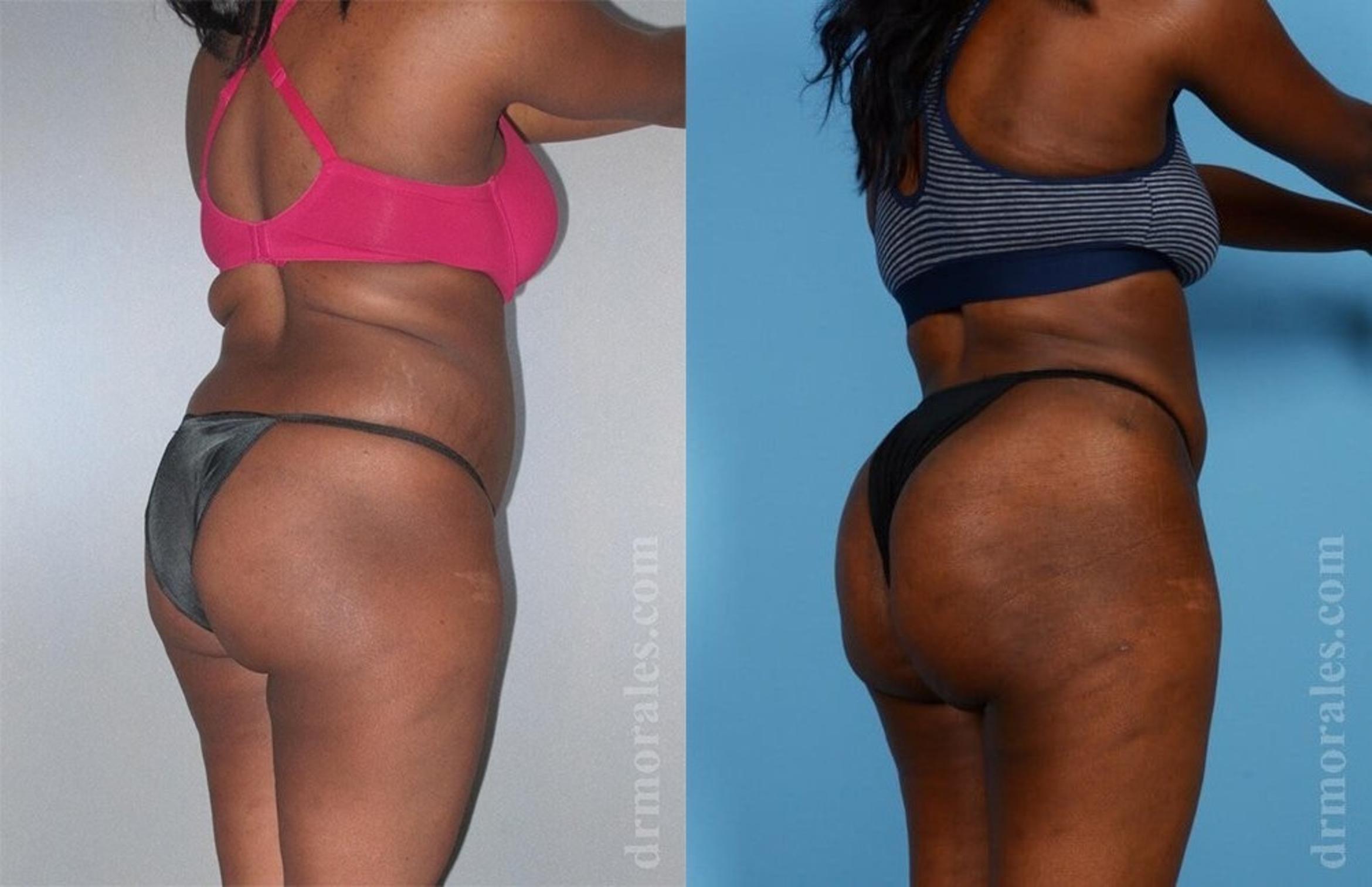 Before & After Brazilian Butt Lift Case 372 View 1 View in Houston, TX
