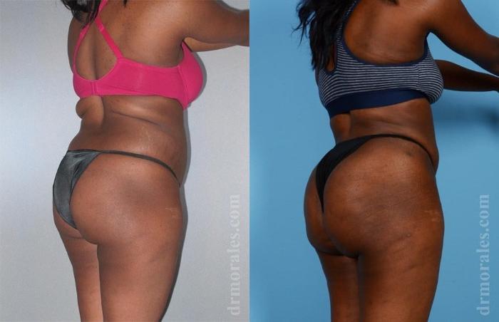 Before & After Brazilian Butt Lift Case 372 View 1 View in Houston, TX