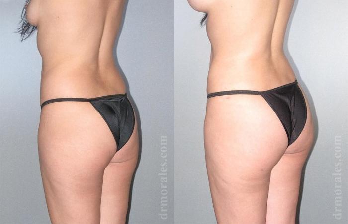 Before & After Brazilian Butt Lift Case 373 View 1 View in Houston, TX