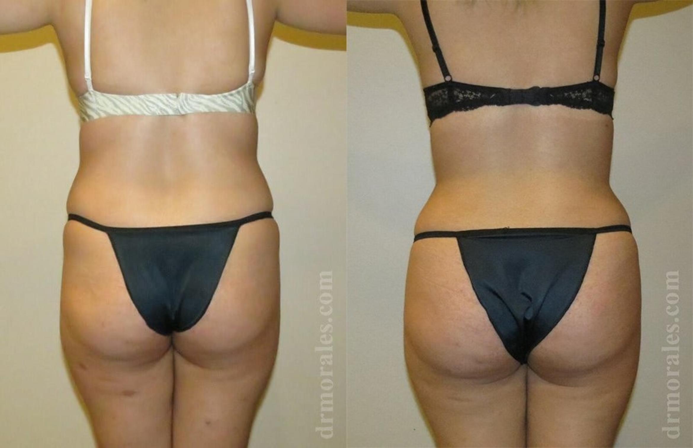 Before & After Brazilian Butt Lift Case 374 View 1 View in Houston, TX
