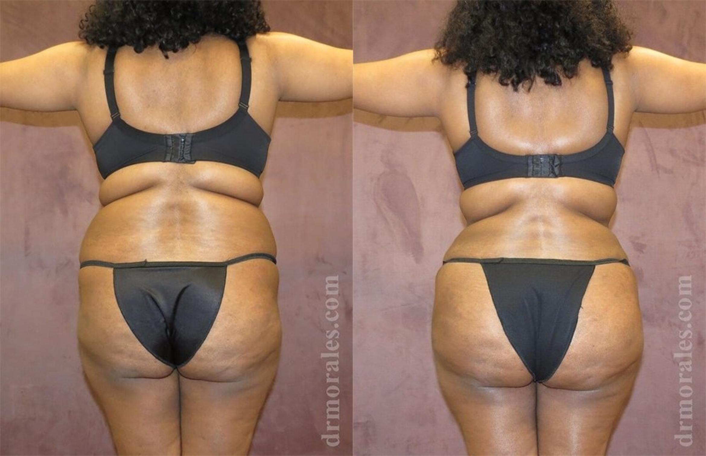 Before & After Brazilian Butt Lift Case 375 View 1 View in Houston, TX