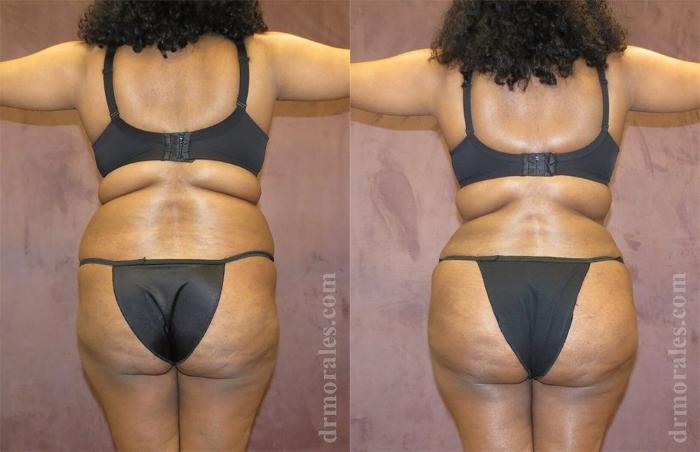 Before & After Brazilian Butt Lift Case 375 View 1 View in Houston, TX