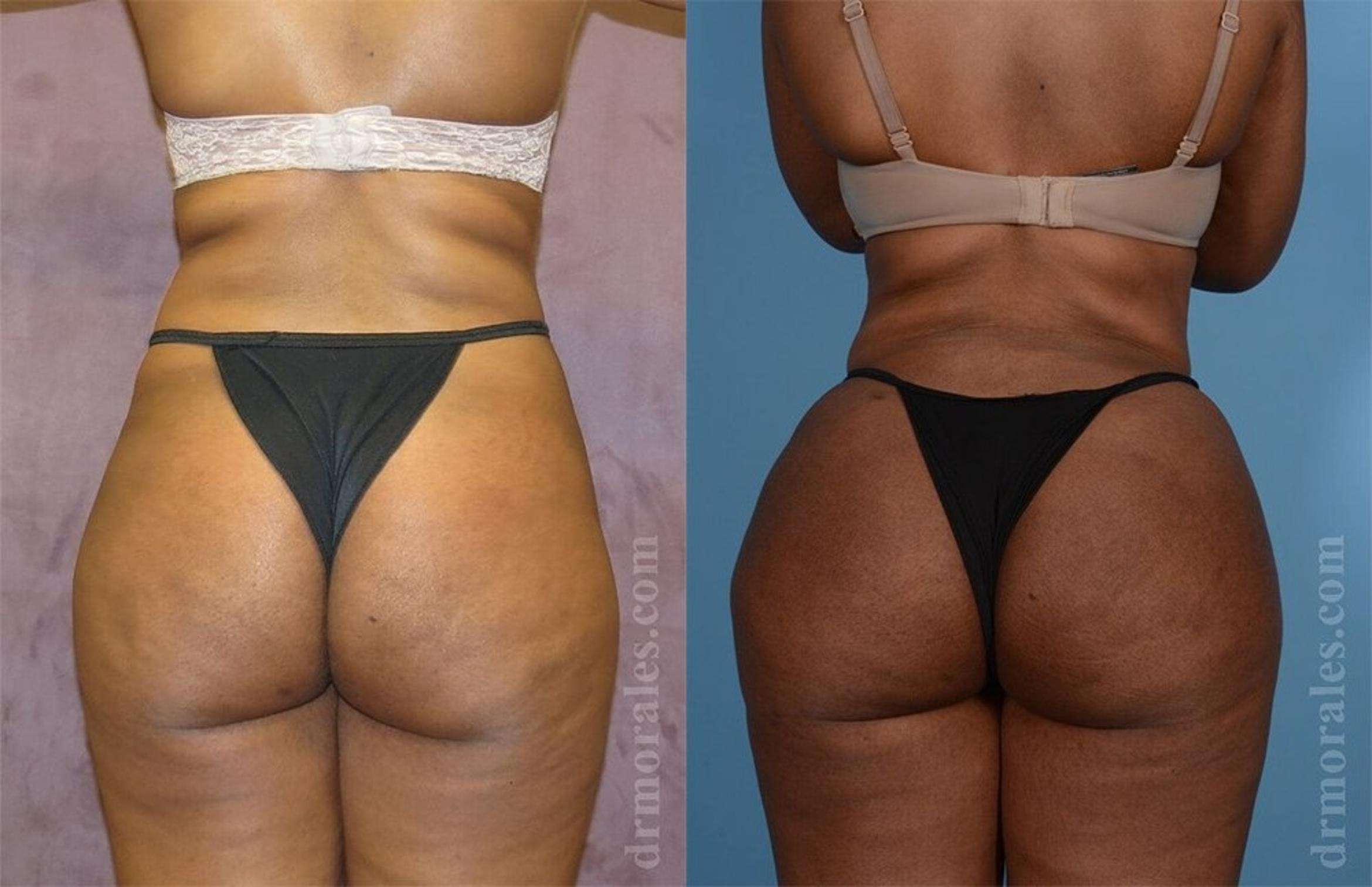 Before & After Brazilian Butt Lift Case 376 View 1 View in Houston, TX