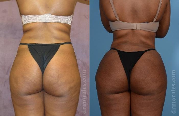Before & After Brazilian Butt Lift Case 376 View 1 View in Houston, TX