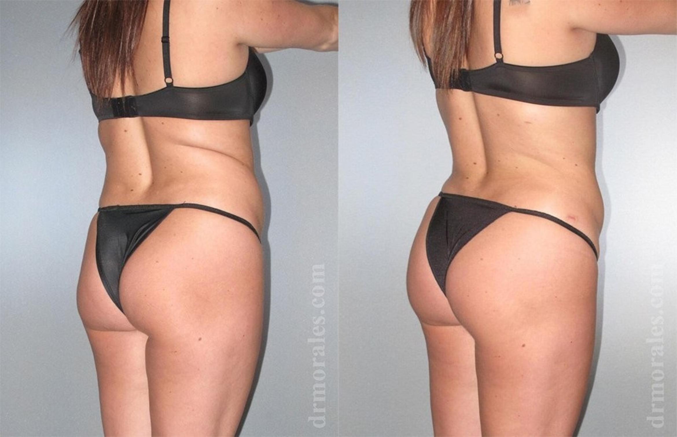 Before & After Brazilian Butt Lift Case 377 View 1 View in Houston, TX