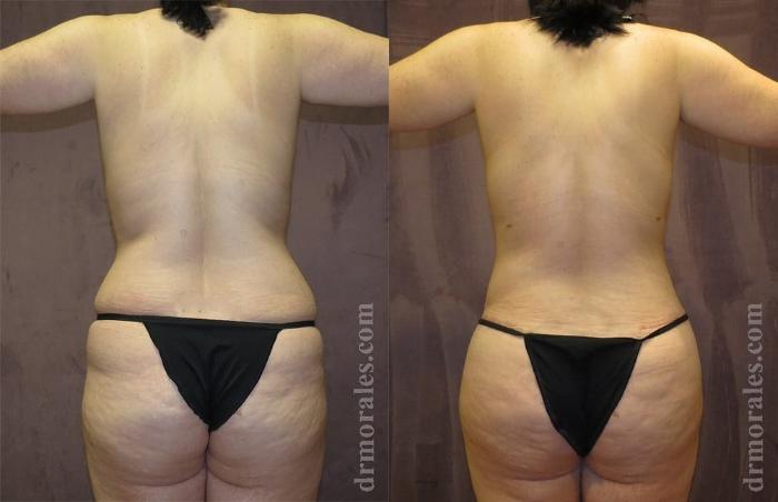 Before & After Brazilian Butt Lift Case 378 View 1 View in Houston, TX