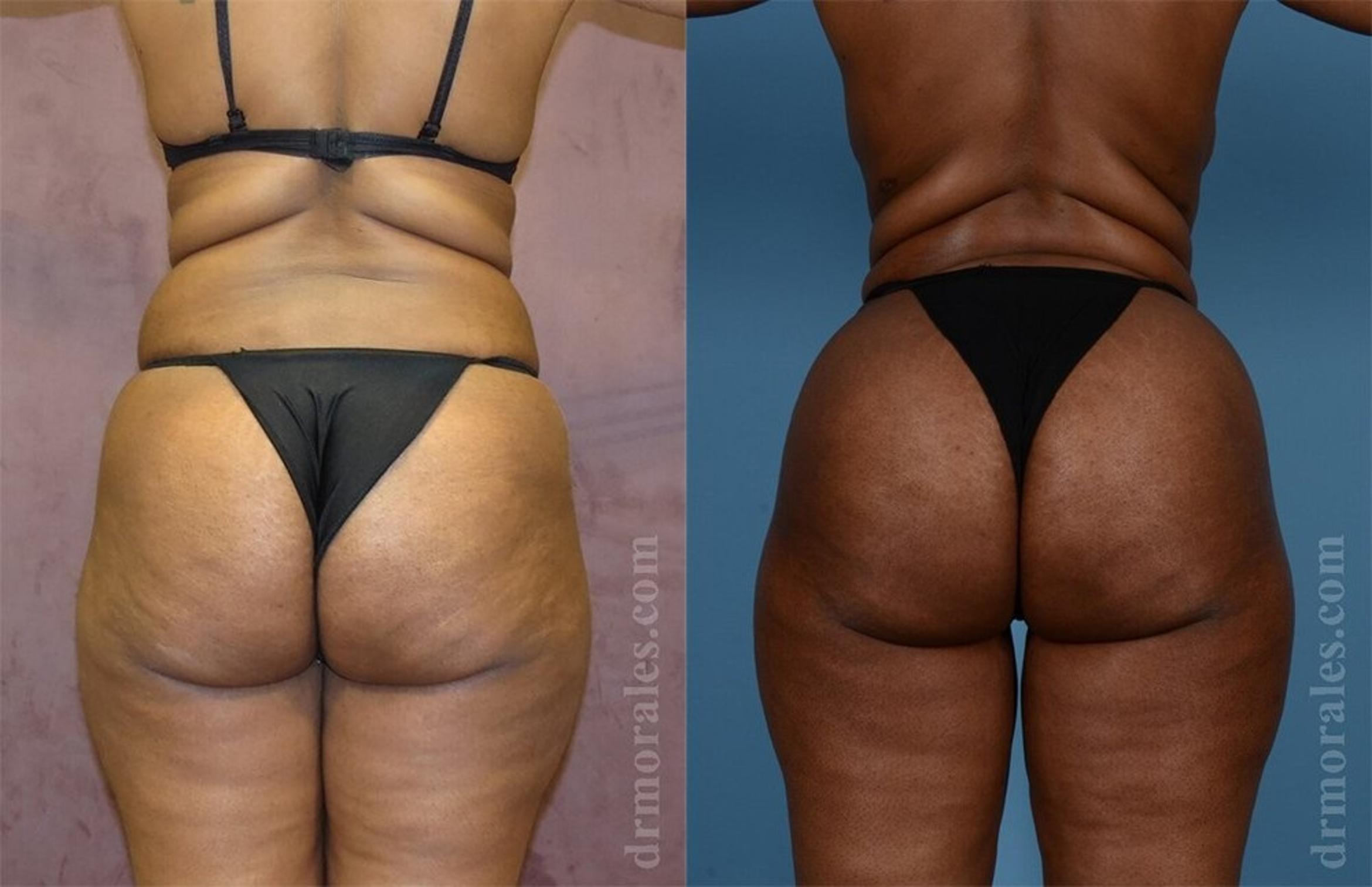Before & After Brazilian Butt Lift Case 379 View 1 View in Houston, TX