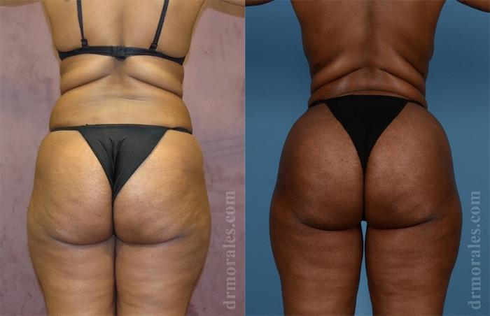 Before & After Brazilian Butt Lift Case 379 View 1 View in Houston, TX