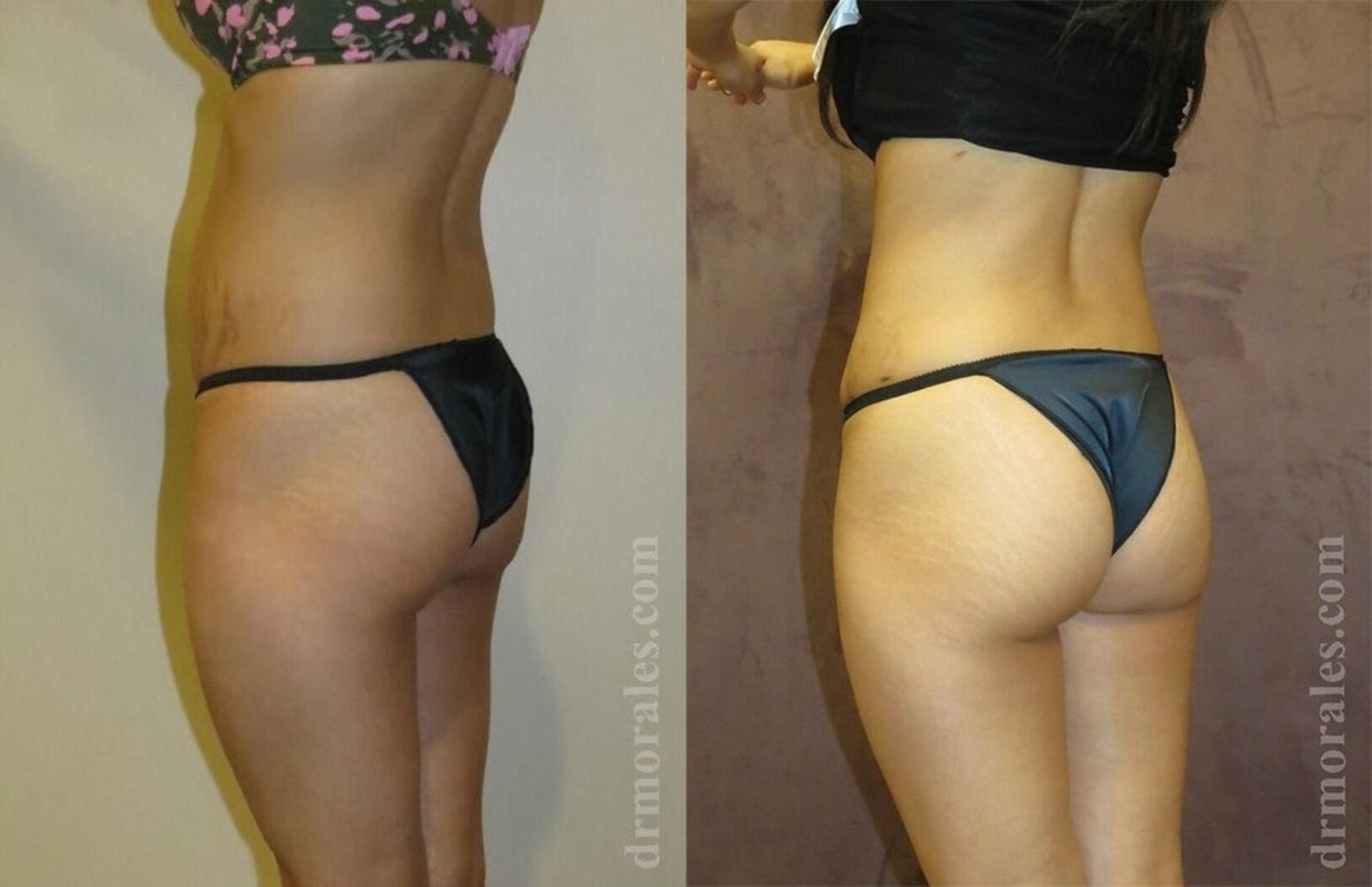 Before & After Brazilian Butt Lift Case 380 View 1 View in Houston, TX