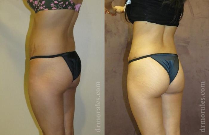 Before & After Brazilian Butt Lift Case 380 View 1 View in Houston, TX
