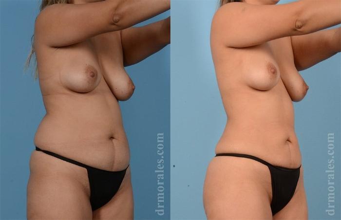 Before & After Brazilian Butt Lift Case 381 View 1 View in Houston, TX
