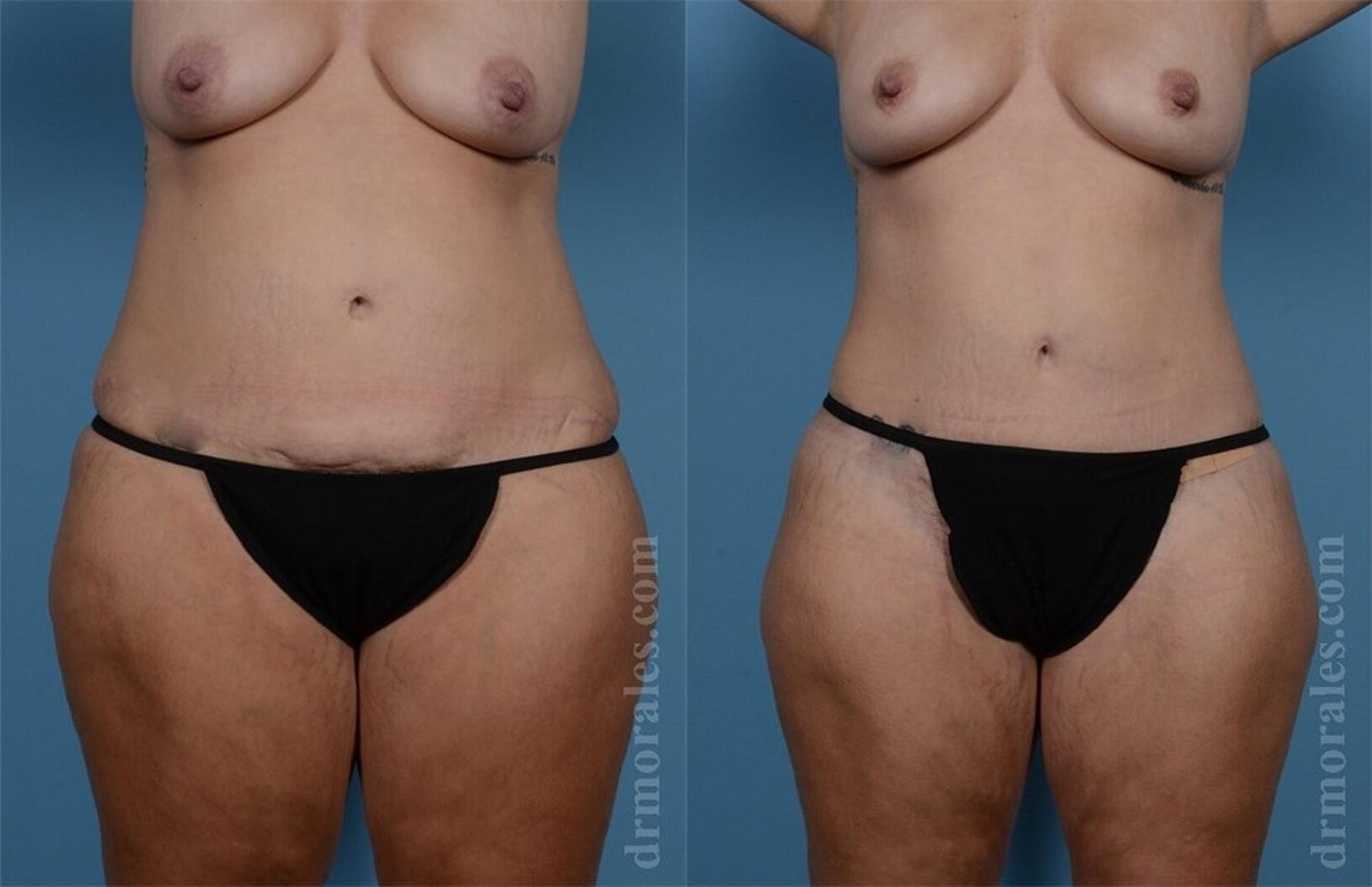 Before & After Brazilian Butt Lift Case 382 View 1 View in Houston, TX