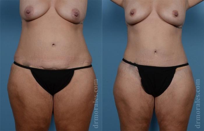 Before & After Brazilian Butt Lift Case 382 View 1 View in Houston, TX