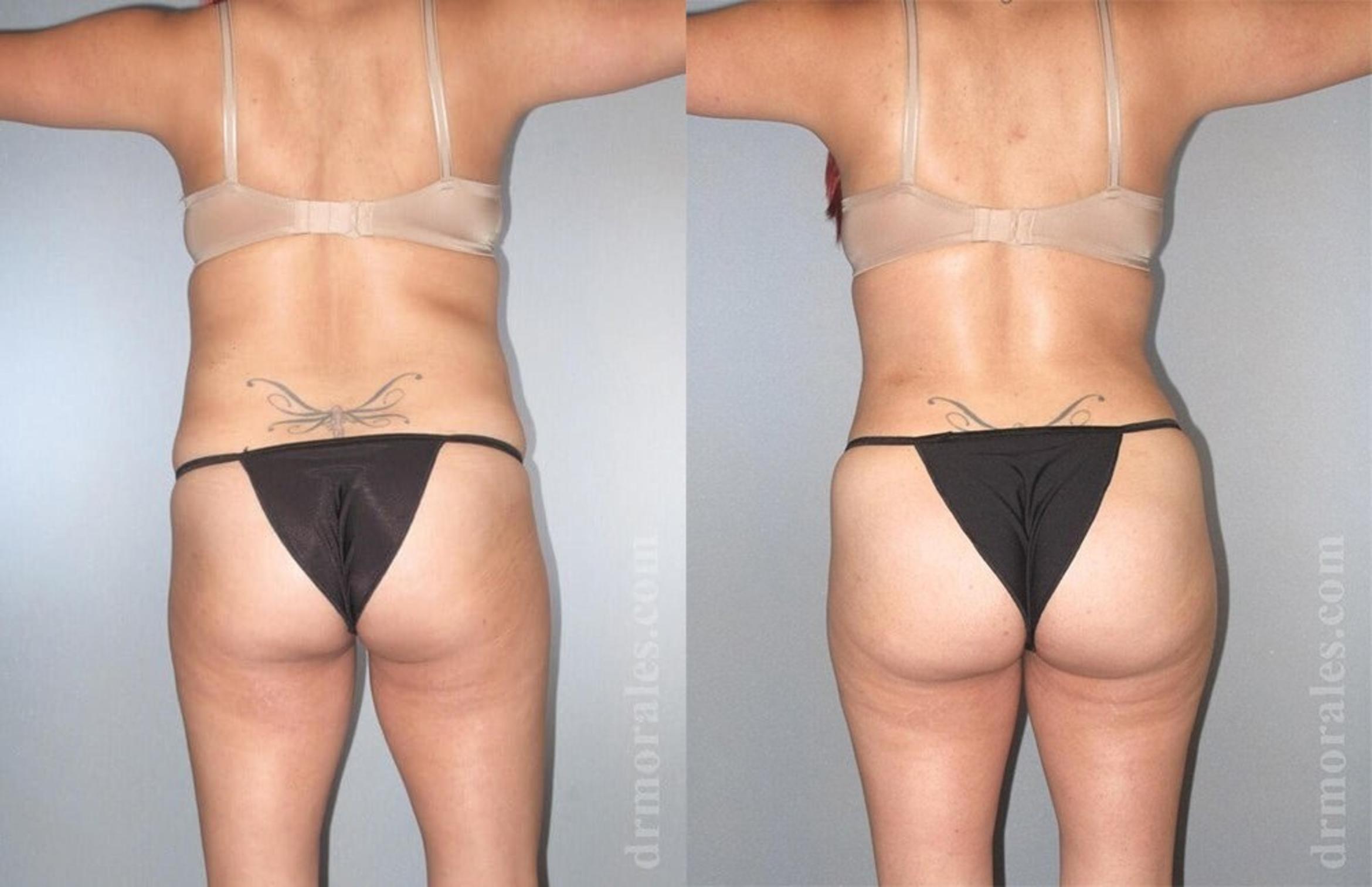 Before & After Brazilian Butt Lift Case 383 View 1 View in Houston, TX