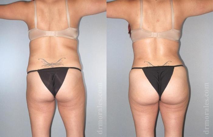 Before & After Brazilian Butt Lift Case 383 View 1 View in Houston, TX