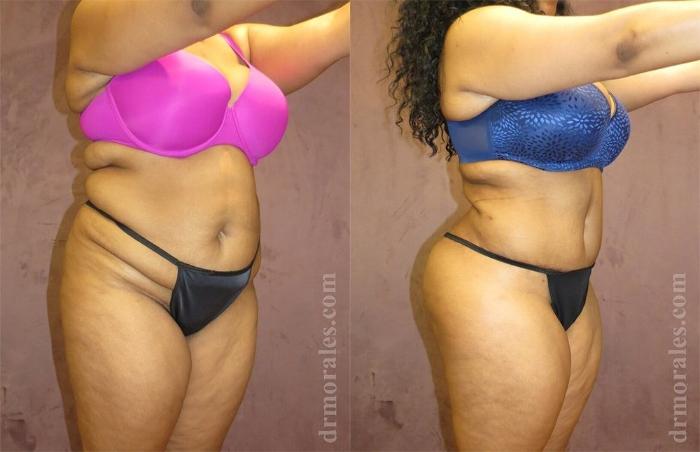 Before & After Brazilian Butt Lift Case 384 View 1 View in Houston, TX