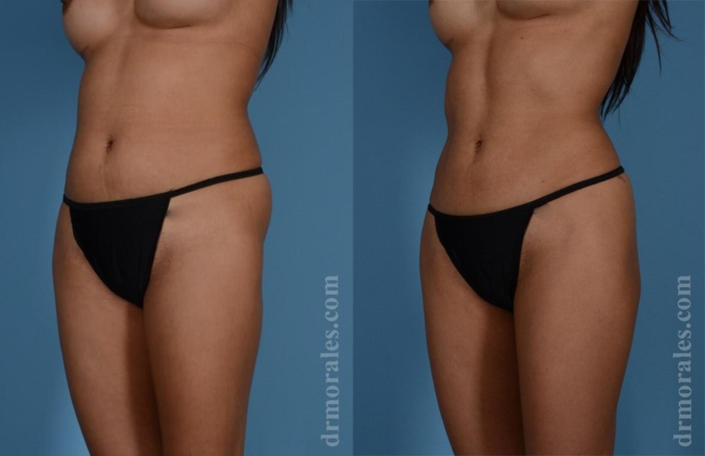 Before & After Brazilian Butt Lift Case 385 View 1 View in Houston, TX