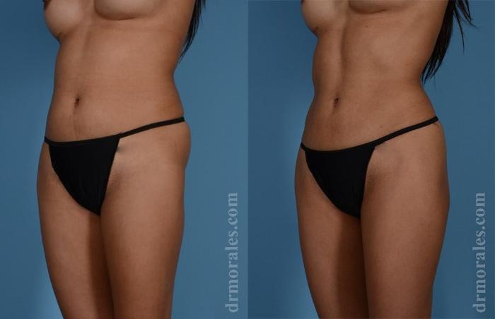 Before & After Brazilian Butt Lift Case 385 View 1 View in Houston, TX