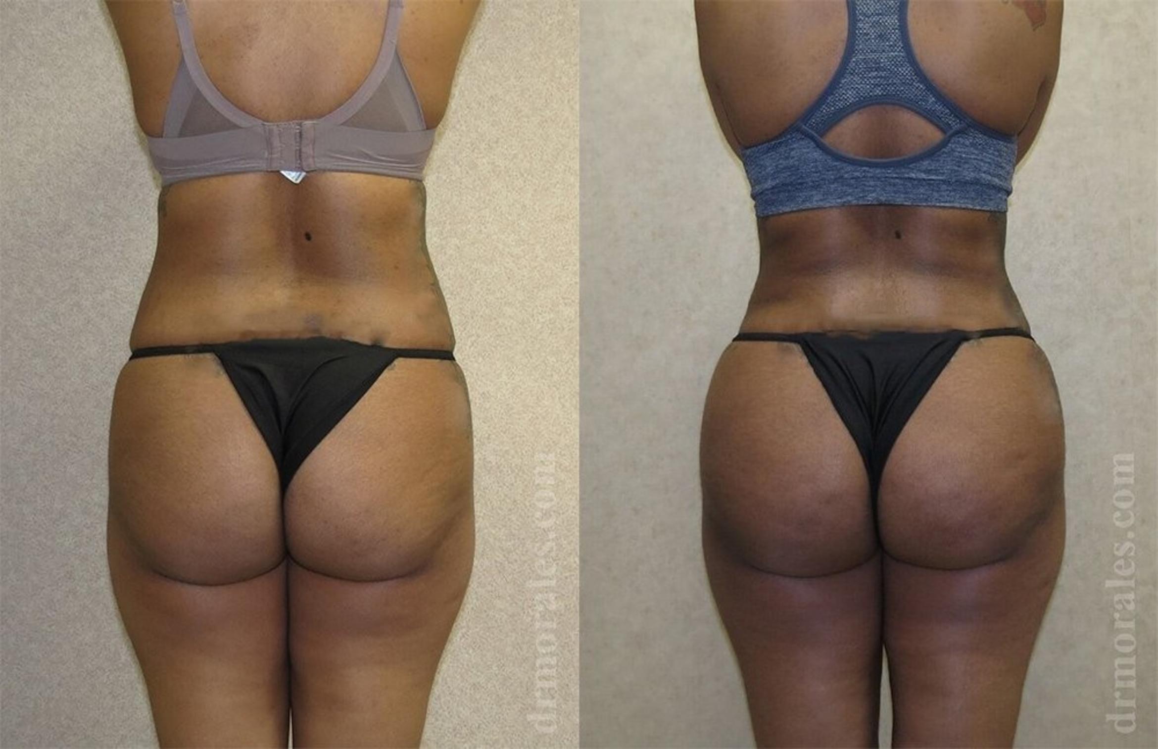 Before & After Brazilian Butt Lift Case 386 View 1 View in Houston, TX