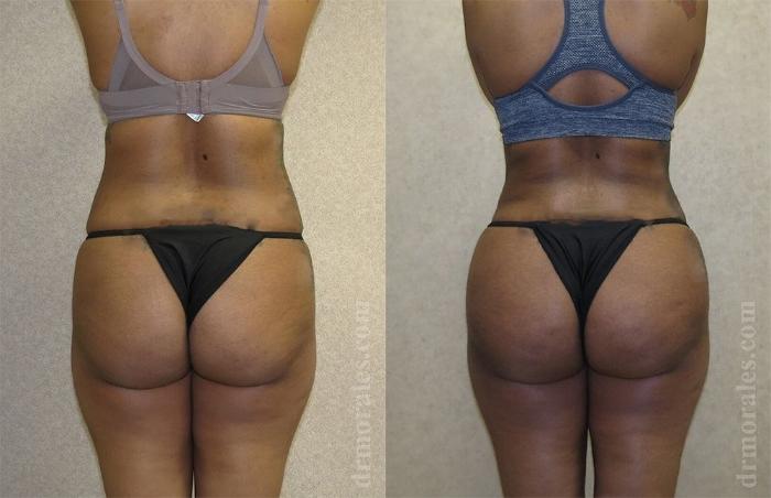 Before & After Brazilian Butt Lift Case 386 View 1 View in Houston, TX