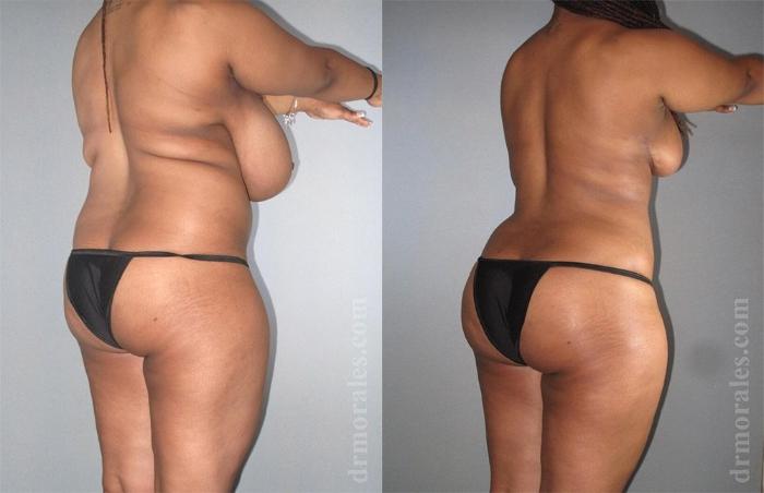 Before & After Brazilian Butt Lift Case 387 View 1 View in Houston, TX