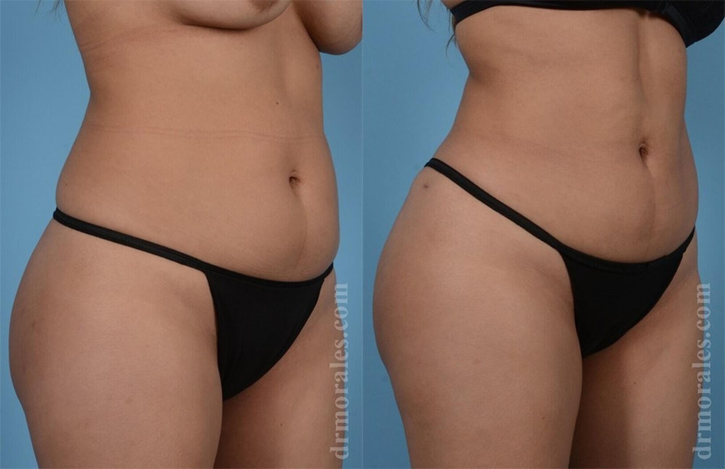 Before & After Brazilian Butt Lift Case 388 View 1 View in Houston, TX