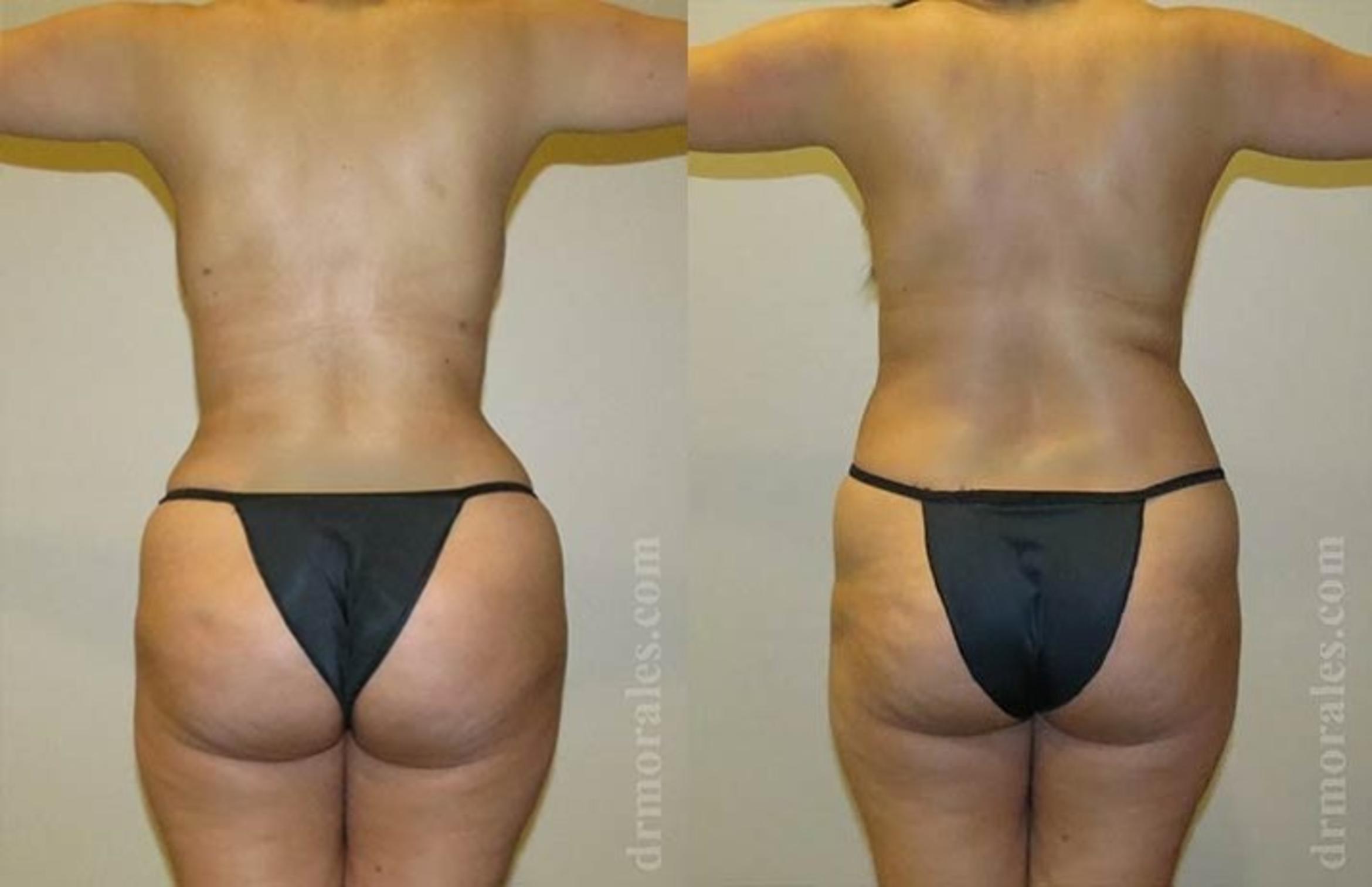 Before & After Brazilian Butt Lift Case 389 View 1 View in Houston, TX