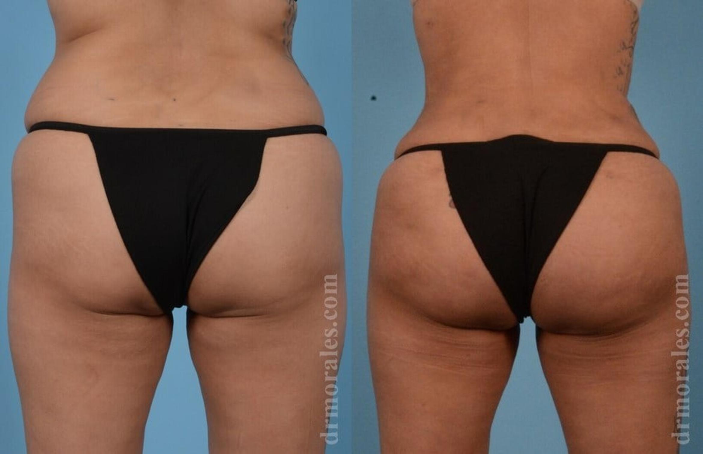 Before & After Brazilian Butt Lift Case 390 View 1 View in Houston, TX