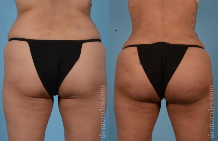 Before & After Brazilian Butt Lift Case 390 View 1 View in Houston, TX