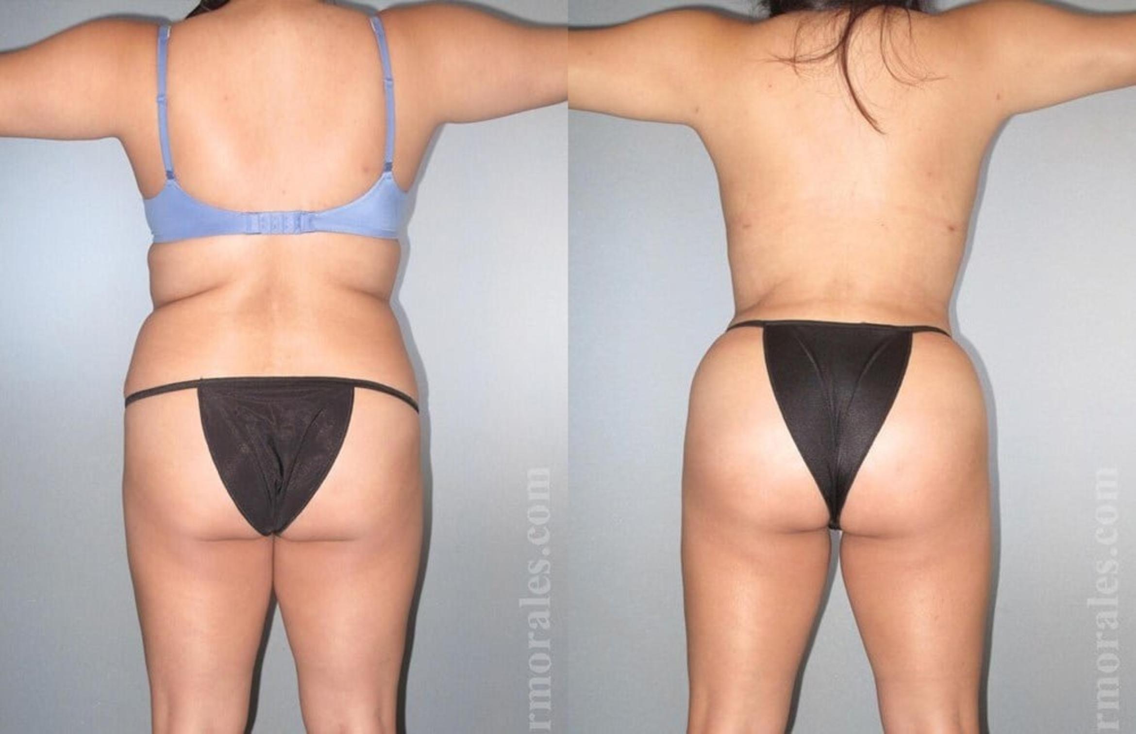 Before & After Brazilian Butt Lift Case 391 View 1 View in Houston, TX