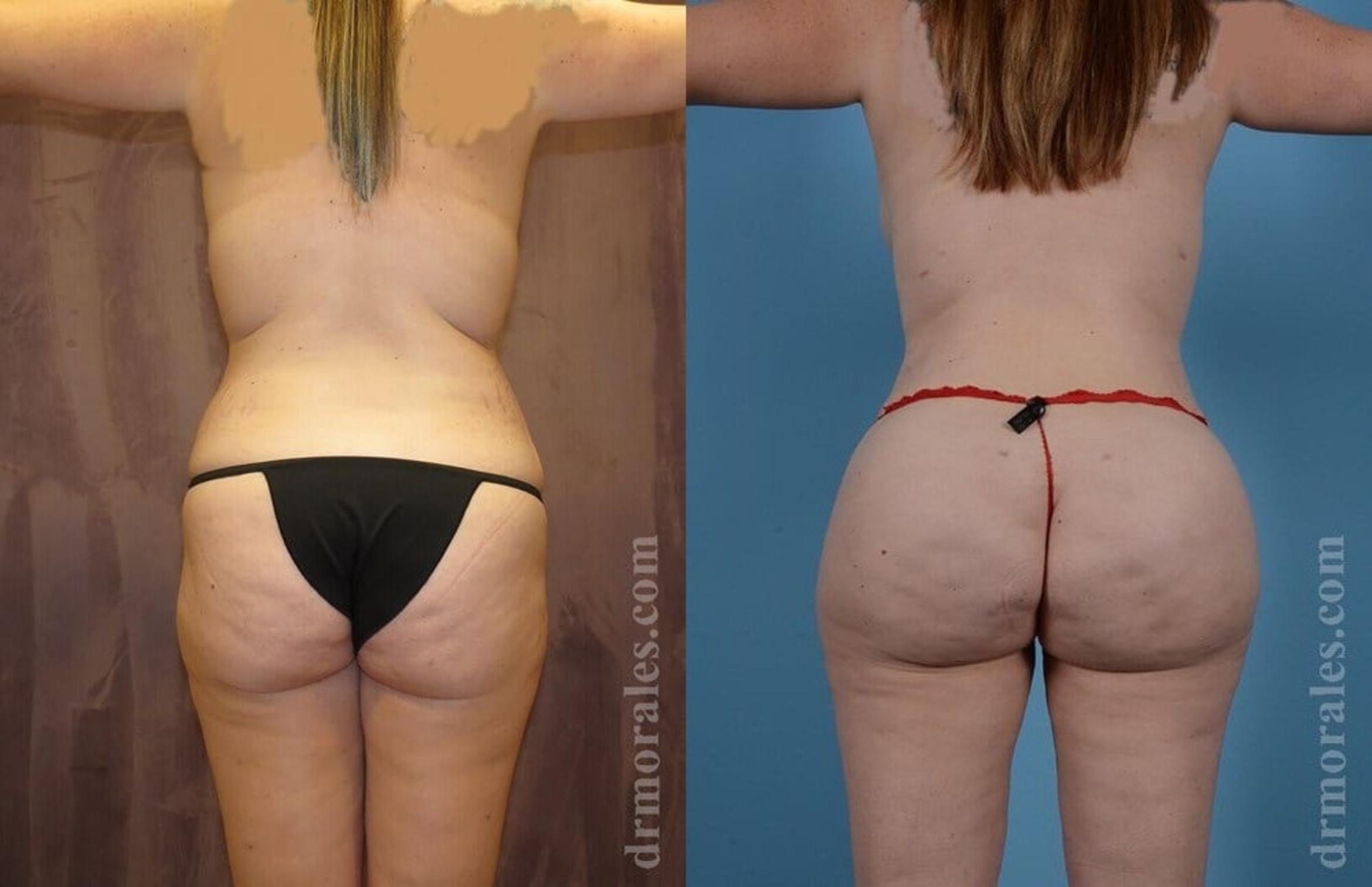 Before & After Brazilian Butt Lift Case 392 View 1 View in Houston, TX