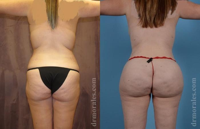 Before & After Brazilian Butt Lift Case 392 View 1 View in Houston, TX