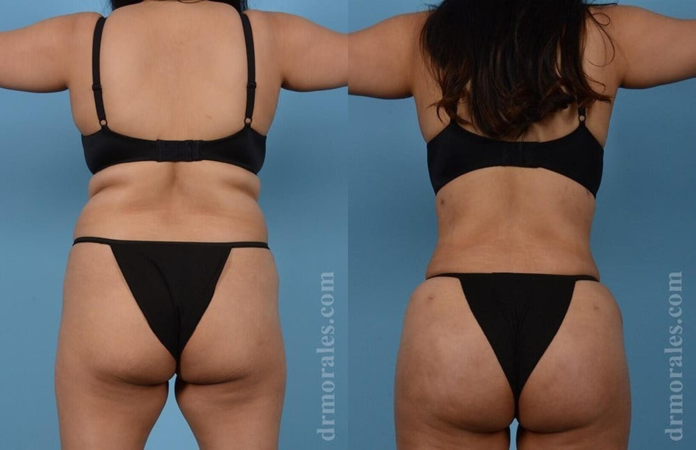 Before & After Brazilian Butt Lift Case 393 View 1 View in Houston, TX