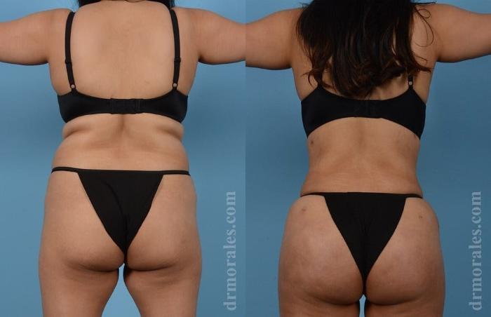 Before & After Brazilian Butt Lift Case 393 View 1 View in Houston, TX