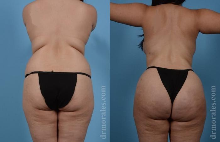 Before & After Brazilian Butt Lift Case 394 View 1 View in Houston, TX