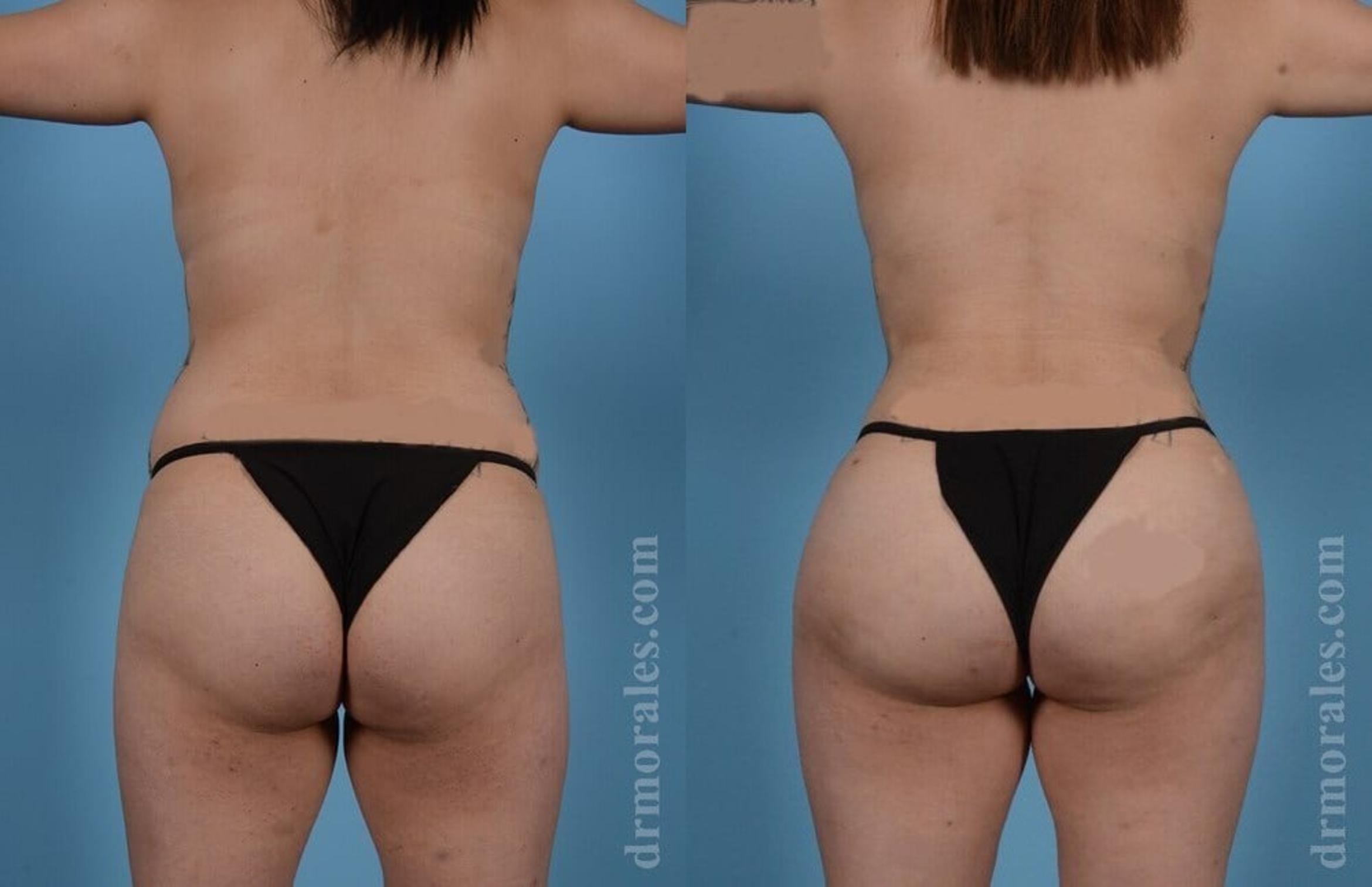 Before & After Brazilian Butt Lift Case 395 View 1 View in Houston, TX