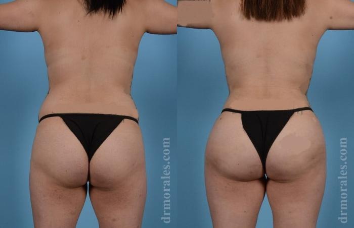 Before & After Brazilian Butt Lift Case 395 View 1 View in Houston, TX