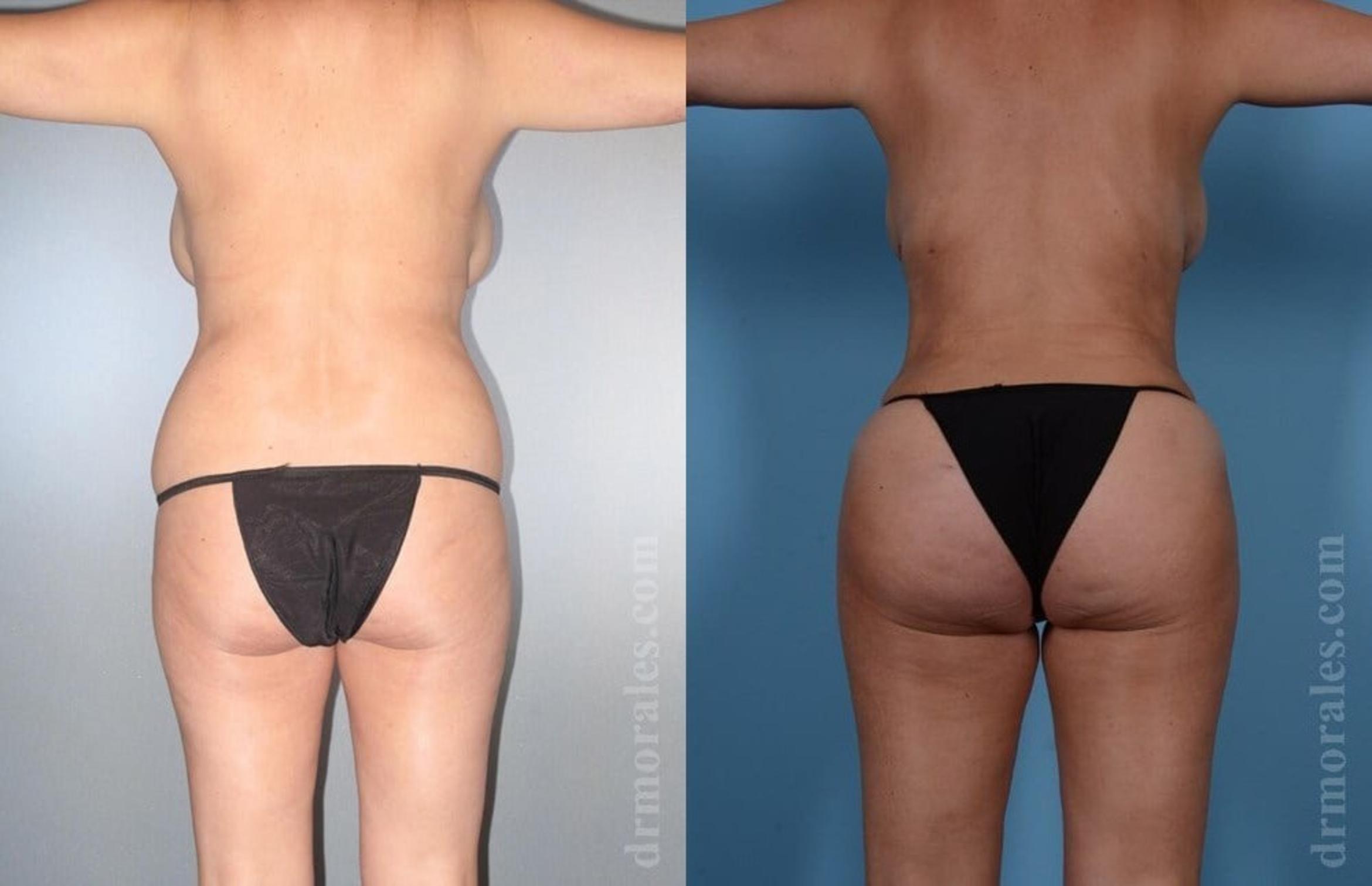 Before & After Brazilian Butt Lift Case 396 View 1 View in Houston, TX