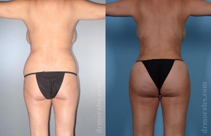 Before & After Brazilian Butt Lift Case 396 View 1 View in Houston, TX