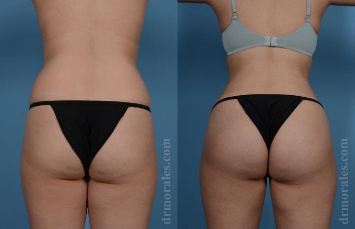 Before & After Brazilian Butt Lift Case 397 View 1 View in Houston, TX