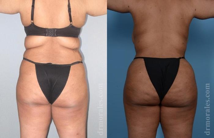 Before & After Brazilian Butt Lift Case 398 View 1 View in Houston, TX